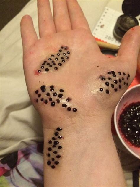 Trypophobia Skin Disease Hand