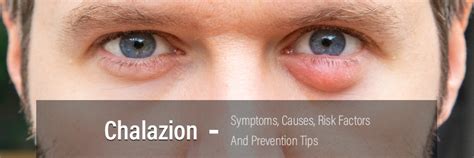 Chalazion- Symptoms, Causes, Risk Factors and Prevention Tips