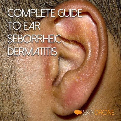 Seborrheic Eczema In Ear