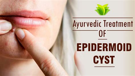 Ayurvedic Treatment for Epidermoid Cysts