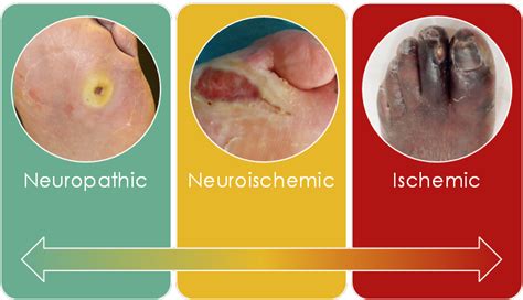 Foot Ulcers: Spectrum of Ischemia | Michael Cumming, MD, MBA