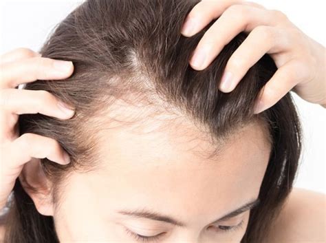 Androgenetic Alopecia: Causes, Symptoms and Treatment