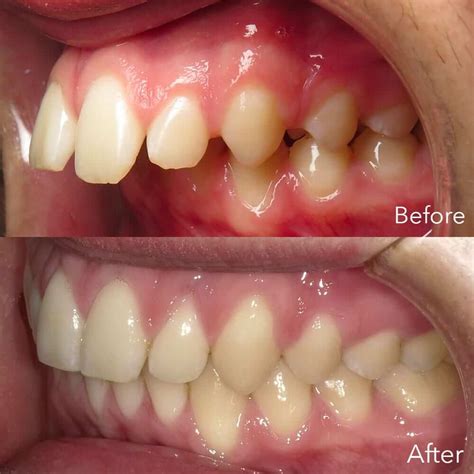 Can You Fix An Overbite Naturally / 3 Easy Steps You Can Take To Fix ...