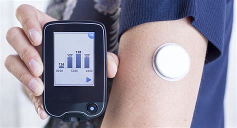 Abbott, Tandem Diabetes Care partner to integrate tech for automated insulin delivery systems