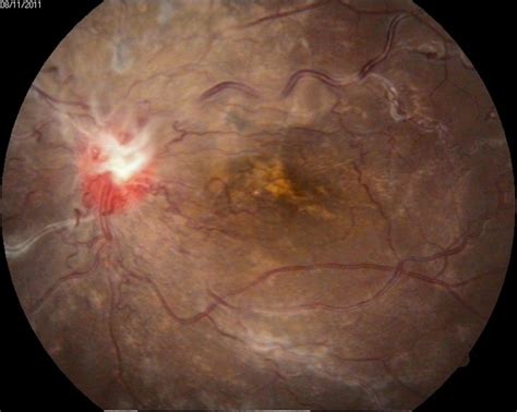 Racemose Hemangioma and Retinal Vein Occlusion - Retina Image Bank