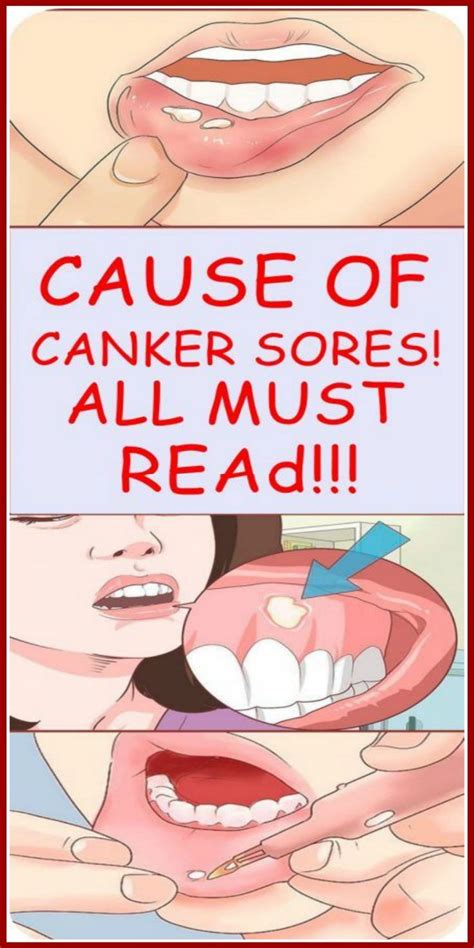 CAUSE OF CANKER SORES. ALL MUST READ…!!! | Canker sore causes, Canker sore, Cankers