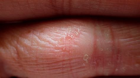 Dyshidrotic Eczema Finger