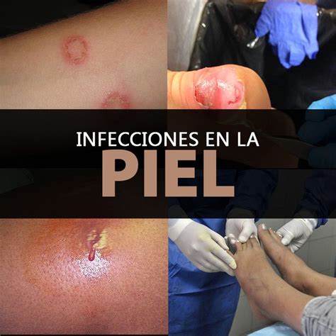 Infecciones-piel-portada1 | La Guía de las Vitaminas