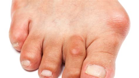 Foot Bunion - Causes, Symptoms, and Treatment To Correct Bunion