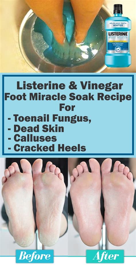 Listerine & Vinegar Foot Miracle Soak Recipe for Toenail Fungus, Dead Skin, Calluses & Cracked ...