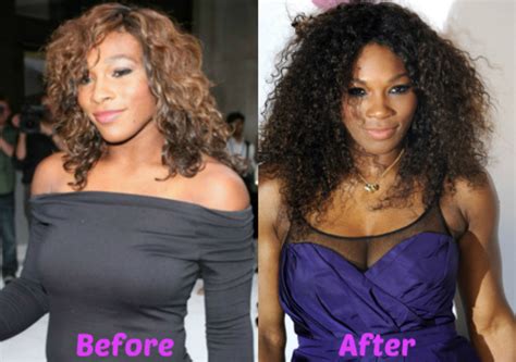 Serena Williams plastic surgery: Before and After Pictures