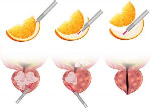 HoLEP Procedure | The Urology Group