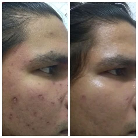 Chicken pox scars after excision.what next? – Scar treatments – Acne.org Forum