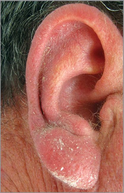 Demodectic Frost of the Ear | Dermatology | JAMA Dermatology | JAMA Network