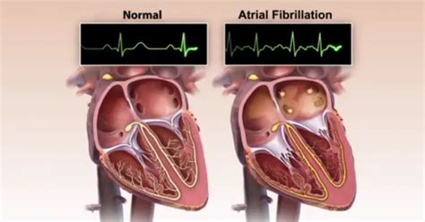 7 Warning Signs of An Irregular Heartbeat (and 5 Ways to Correct It)