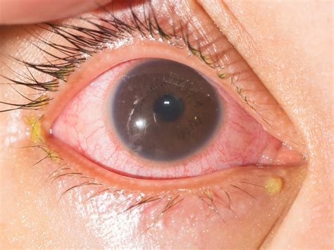 Iritis: Symptoms, Causes & Treatment - Vision Center