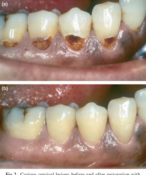 Figure 2 from Glass-ionomer cement restorative materials: a sticky subject? | Semantic Scholar