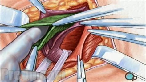 Hernia Repair Inguinal (Open) Surgery Patient Education - Uohere