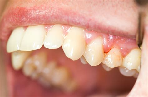 Common Causes of Bleeding Gums - Paducah Dentist