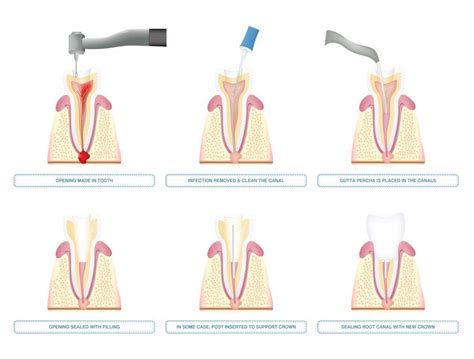 Root Canal NYC - Therapy & Treatment | Midtown Endodontist NYC