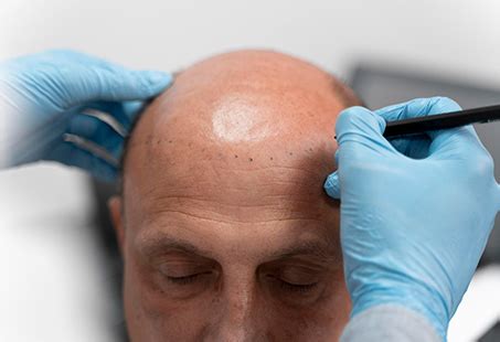 Hair Transplant Side Effects: Long And Short Term | Longevita