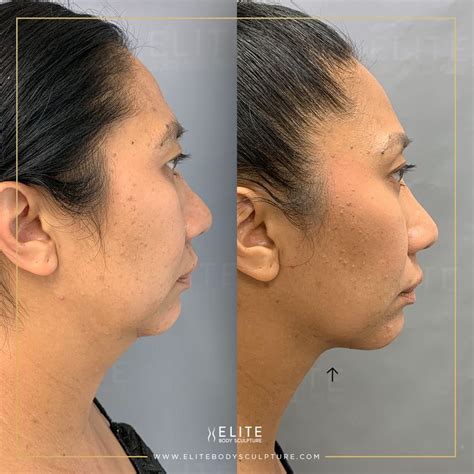 AirSculpt® Before & After - Elite Body Sculpture | Chin, Behind ear ...