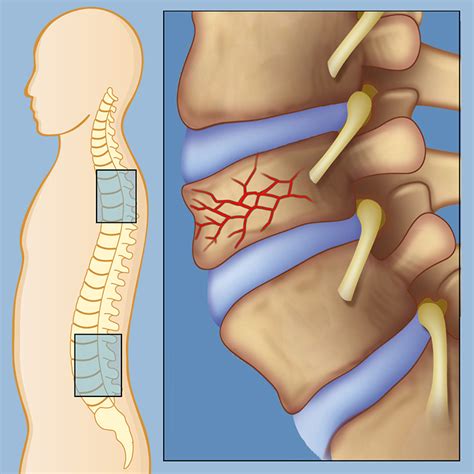 Spinal Compression Fractures | Weill Cornell Brain and Spine Center