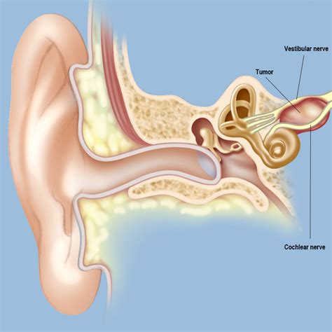 Acoustic Neuromas / Vestibular Schwannomas | Weill Cornell Brain and ...