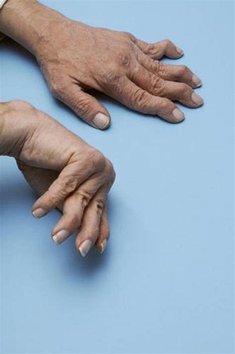 Swan-Neck Deformity - Bone, Joint, and Muscle Disorders - Merck Manuals Consumer Version