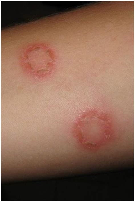 What Causes Ringworm On Your Leg