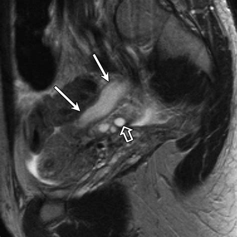 MR Imaging Findings of Hydrosalpinx: A Comprehensive Review | RadioGraphics