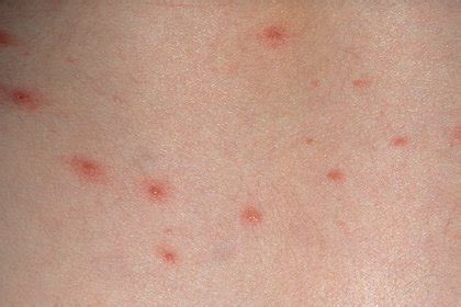 Top 19 stages of shingles rash pictures 2022