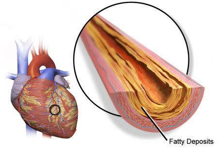 Arteriopatía coronaria - Coronary artery disease - qaz.wiki