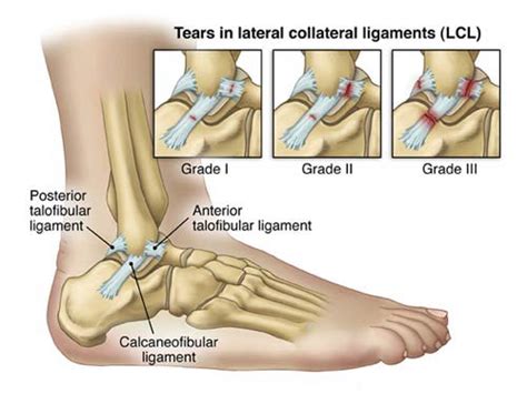 Ankle Ligament Surgery | New Health Advisor