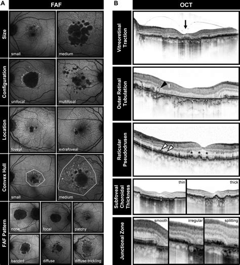 The Progression of Geographic Atrophy Secondary to Age-Related Macular Degeneration - Ophthalmology