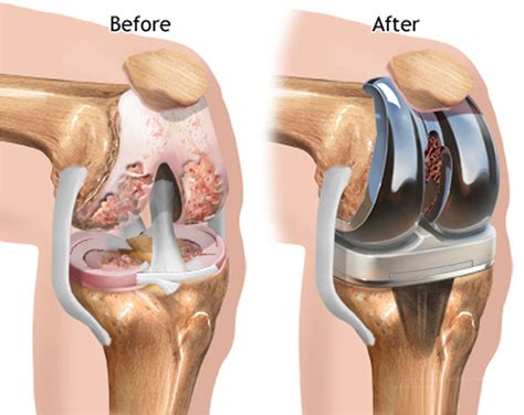 Knee Replacement - Surgery, Recovery Time, Complications