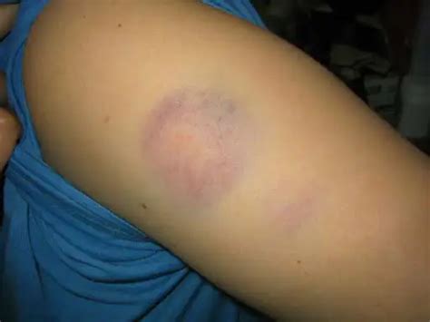 How to Heal Paintball Bruises? Paintball Bruises