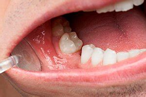 Quais são os efeitos da perda dentária? – Naso