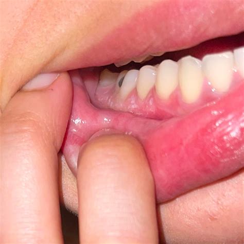 Help I just got these white bumps on my gums! And my tongue burns! : r/Teethcare