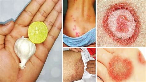 How To Treat Private Part Itching, Fungal Infection - Fungal Ringworm Treatment Home Remedies ...