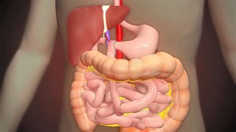 Surgery To Remove Any Part of the Intestine, Bowel Resection Stock Illustration - Illustration ...