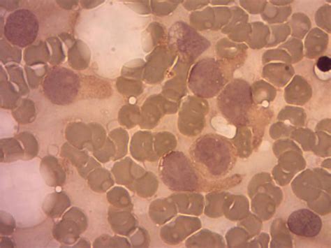 Blastic plasmacytoid dendritic cell neoplasm
