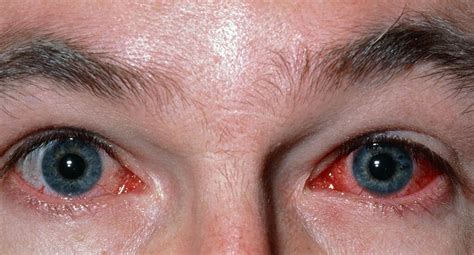Eye Diseases: 10 Common Eye Diseases