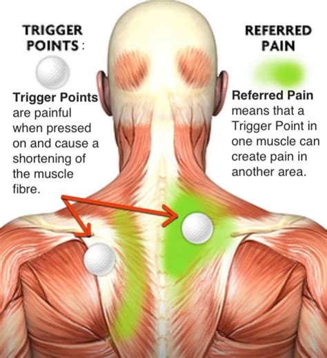 Everything You Need to Know About Trigger Point Massage Therapy