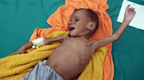 Estimated 85,000 Children Under 5 Years Old May Have Died of Hunger in Yemen: Aid Group | KTLA