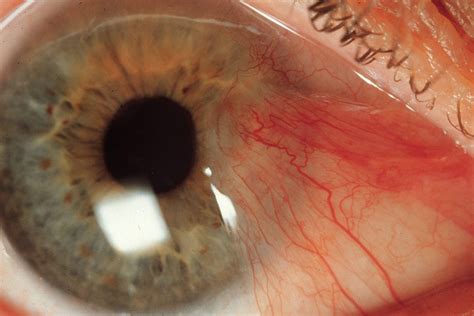 Clinical trial investigates new eye drop therapy for pterygium - Insight