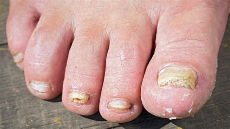 Nail Fungus: Causes, Symptoms, Treatments, And Prevention