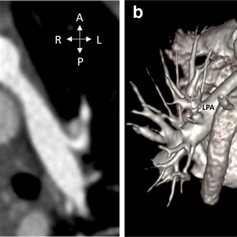 Eleven-year-old girl with d-TGA status post-arterial switch operation.... | Download Scientific ...