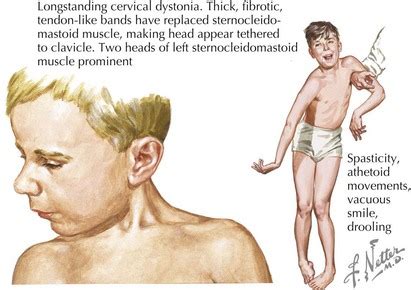 Cerebral Palsy | Obgyn Key