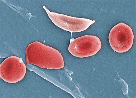Crispr Provides Hope Of Sickle Cell Cure | My XXX Hot Girl